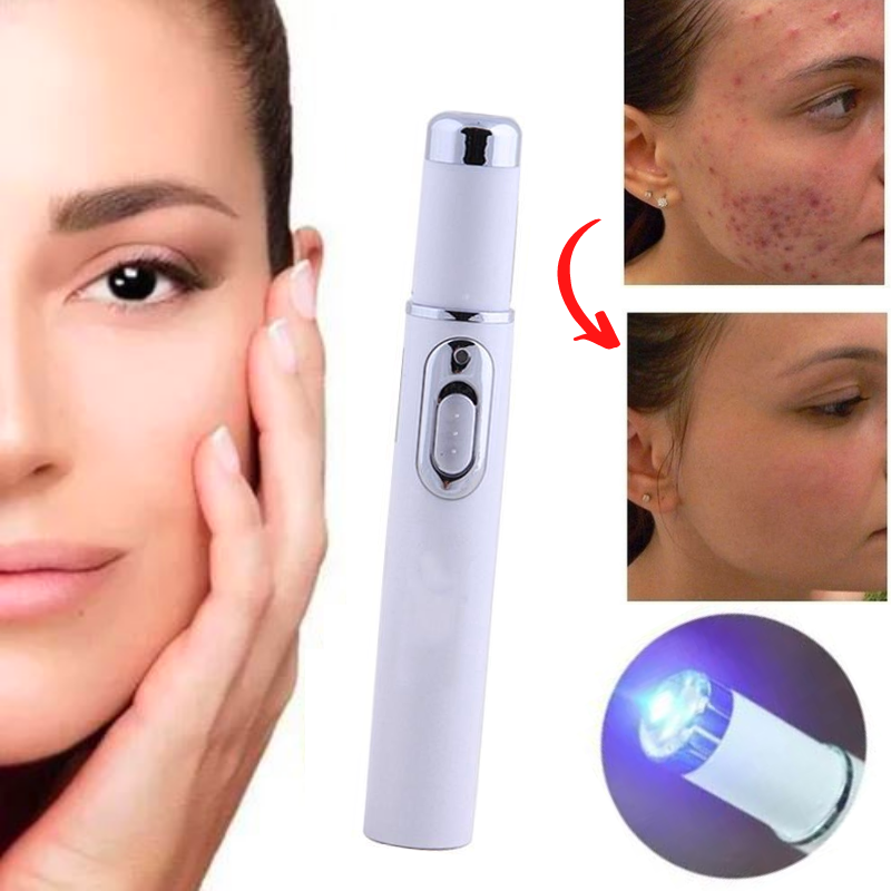 Caneta Laser para Tratamento de Acne, Estrias, Varizes e Sinais - Derma Laser